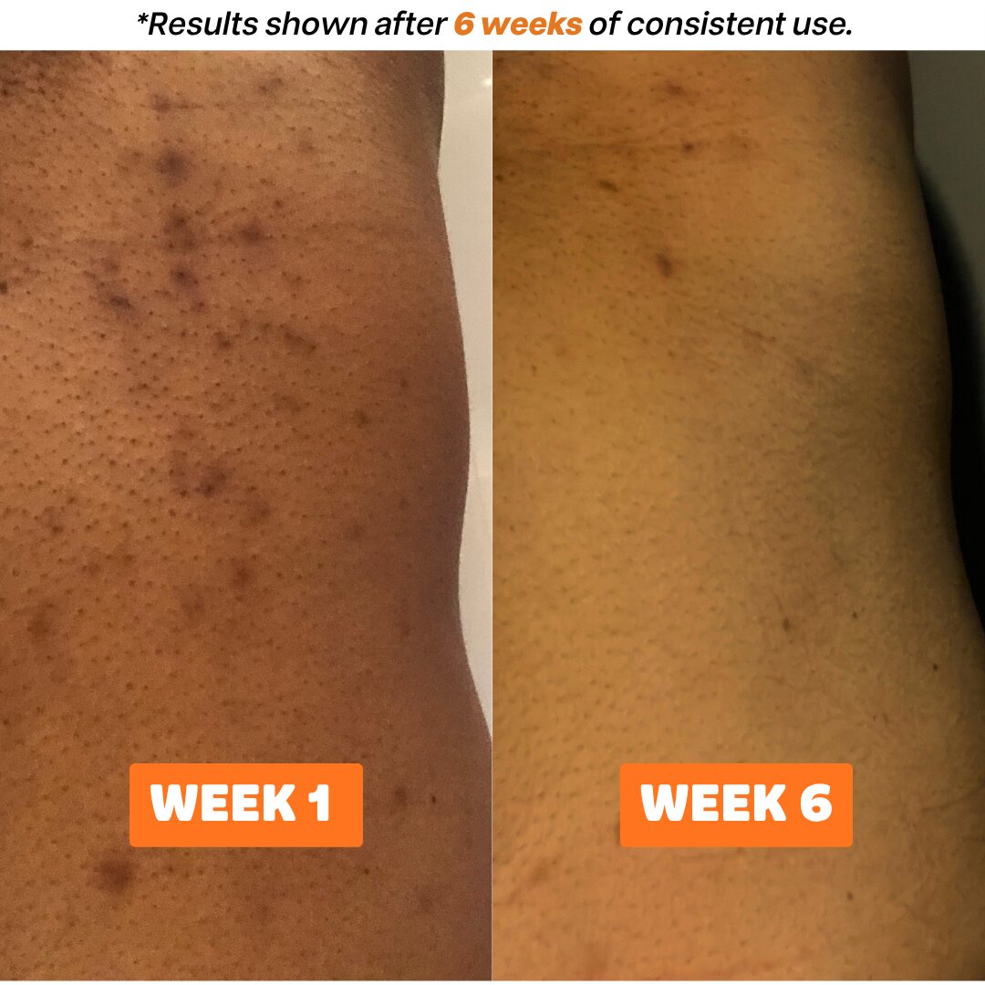 Second image of Bumpz n Stumpz™ Topical Eraser