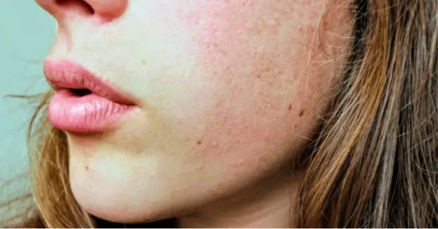 Hydrate and Care for Dry Sensitive Skin: Tips for Different Skin Types