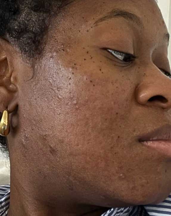 Acne-Buster-Package---Now