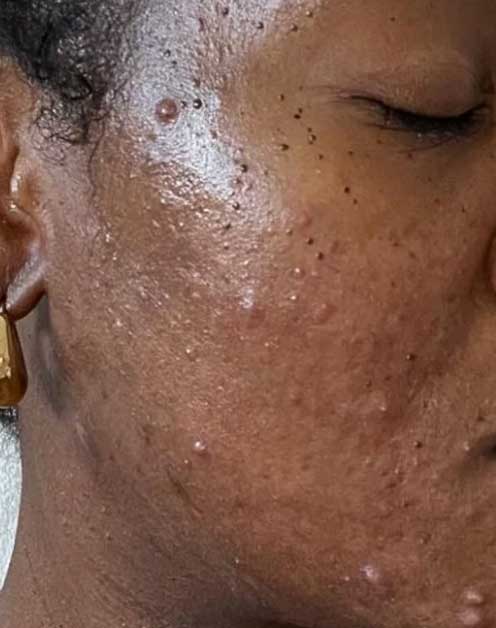 Acne-Buster-Package---Then