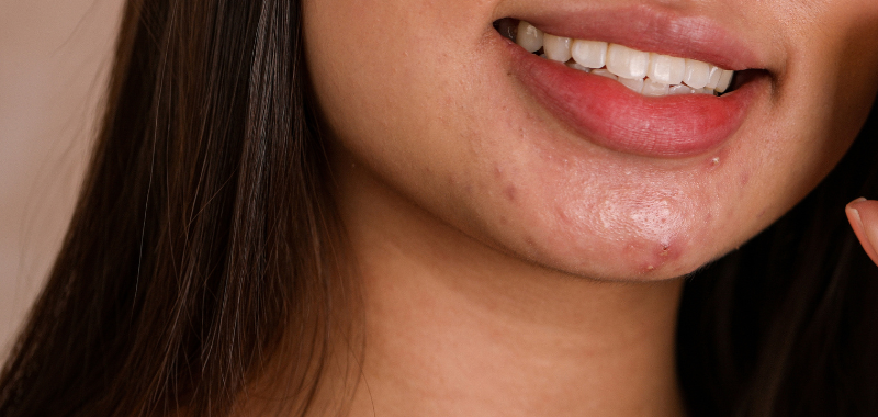 Does Touching Your Face Cause Acne? Here’s What You Need to Know