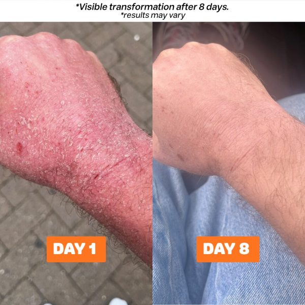 eczema