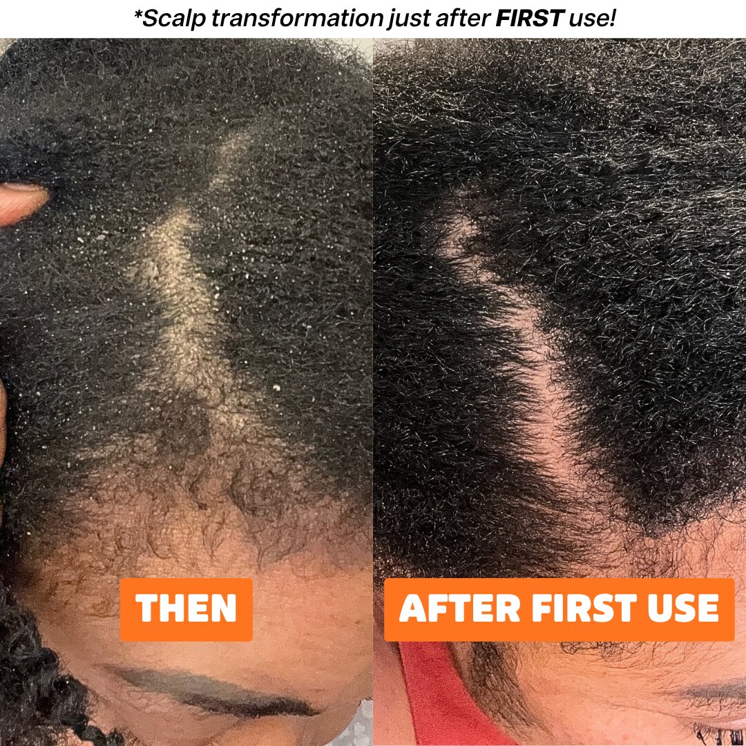 Second image of Seborrheic Dermatitis and Psoriasis Relief Duo