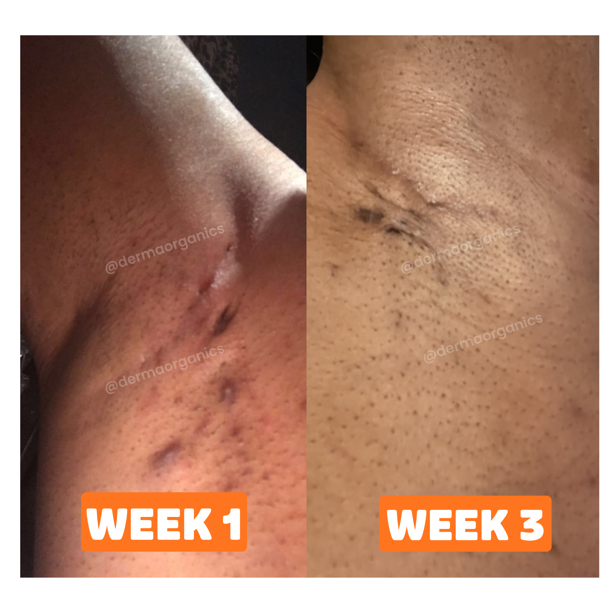 Second image of HS / Boils Relief Kit