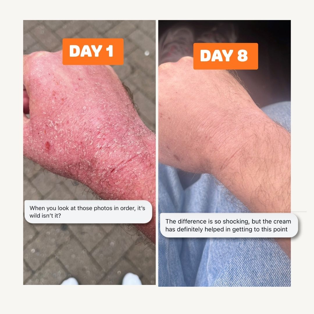 Eczema + Psoriasis + TSW Relief Duo