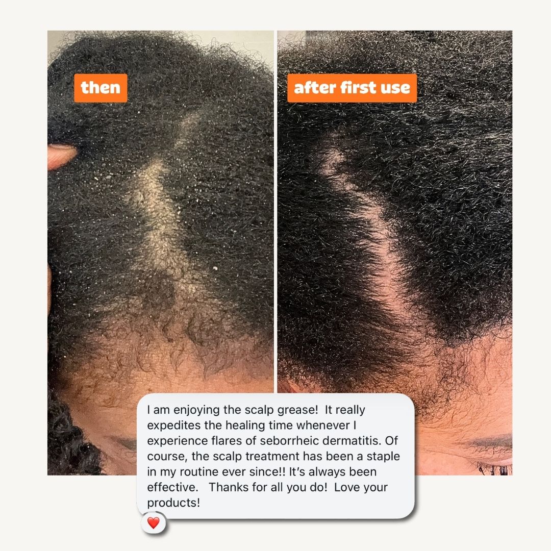 Seborrheic Dermatitis + Psoriasis Relief Bundle