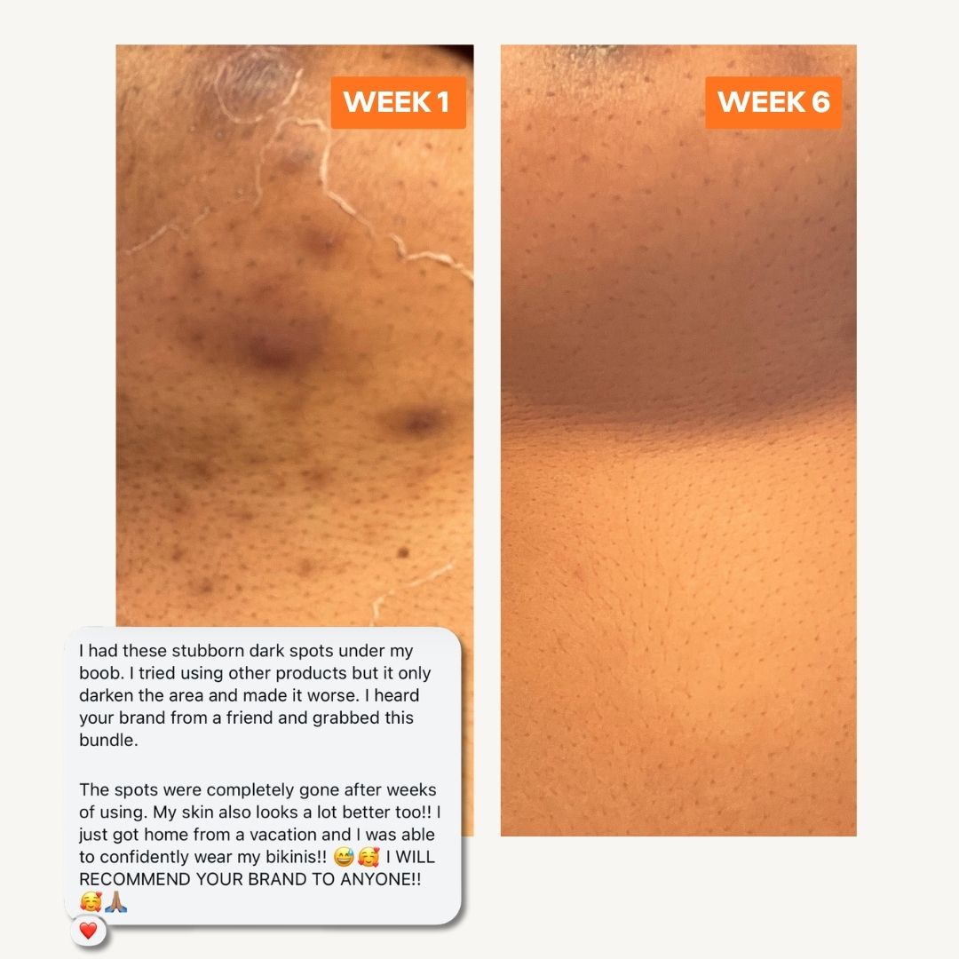 The Dark Spot Corrector Kit